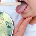 Bacteria estreptococo: qué es, síntomas y cómo prevenirla